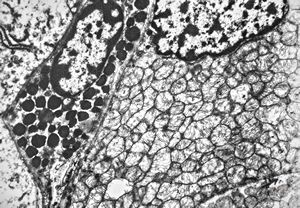 F, 32y. | oncocytic parathyreoideal adenoma F, 32y. | oncocytic parathyreoideal adenoma